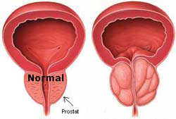 Prostat Hastalıkları